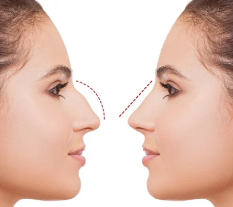 Преобразуйте свой облик с ринопластикой носа