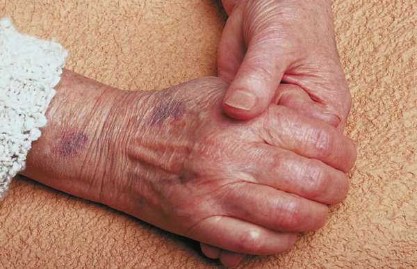 Кровоизлияние под кожей на руке причины