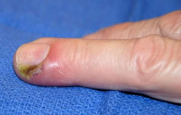 Панариций пальца лечение мкб 10