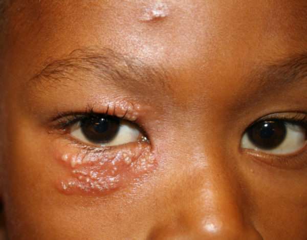 Лечение герпеса на глазу у детей
