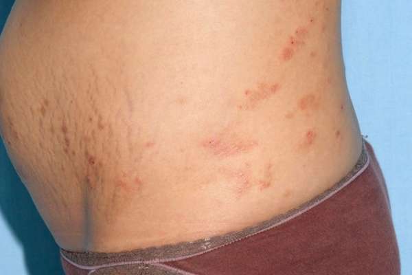 Цинкопан в лечении дерматита у детей thumbnail