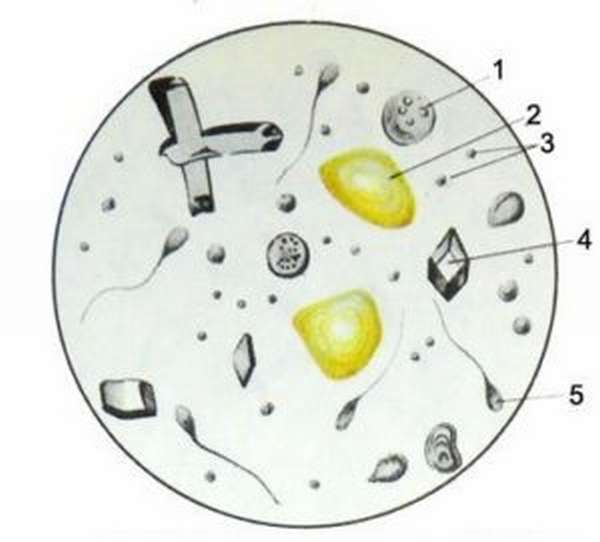 Исследование секрета. Микроскопия секрета простаты. Микроскопия секрета предстательной железы. Сок простаты микроскопия секрета. Лецитиновые зерна в секрете простаты.