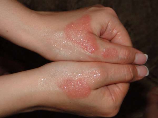 Средство от дерматита на руках