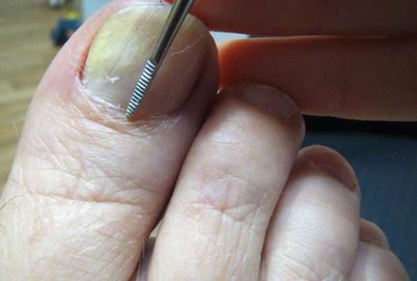Черное пятно на ногте ноги болит thumbnail
