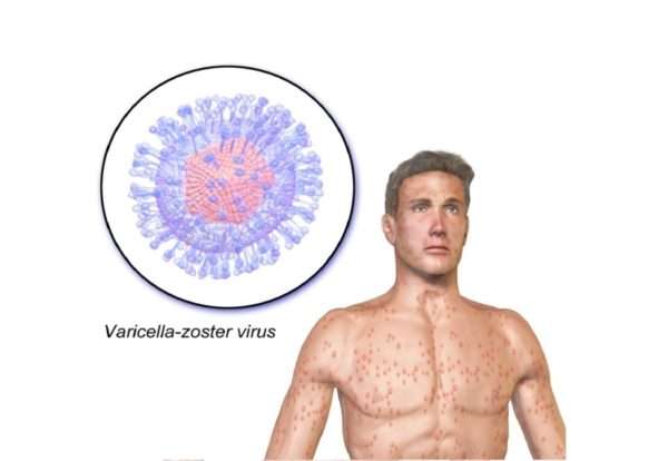 Чем отличается вирус вызывающий ветрянку от бактерии вызывающей холеру