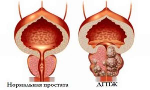 Гиперплазия предстательной железы 