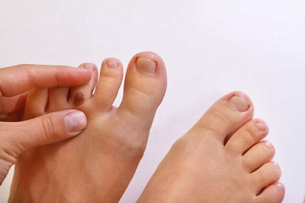 Нарост кожи на большом пальце ноги возле пальца