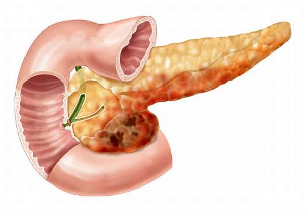 патологические изменения поджелудочной железы