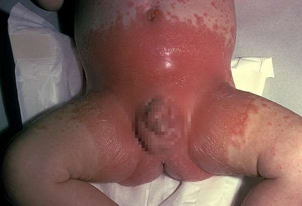 Пимафуцин при дерматите у детей