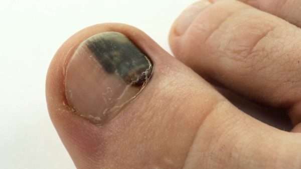 Черное пятно на ногте ноги болит