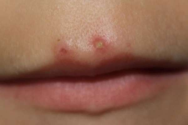 Угревая сыпь над губой