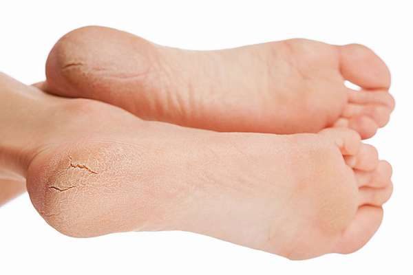 Наросты сухой кожи на пальцах ног