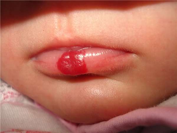 Лечение гемангиомы губы в домашних условиях thumbnail