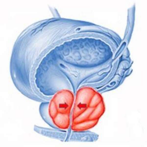 гиперплазия предстательной железы