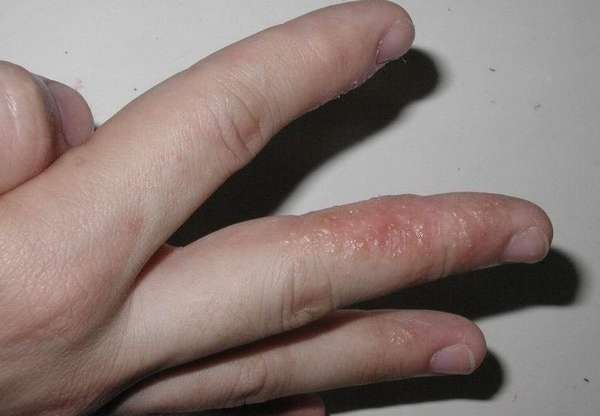 Гнойное воспаление кожи рук