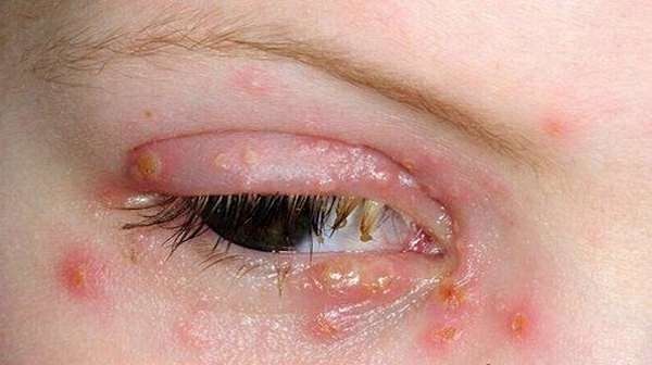 Воспаление глаз у детей при ветрянке