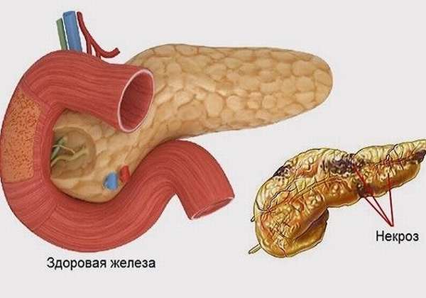 панкреонекроз