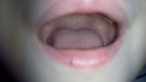 Темные пятна на губах у мужчин. Симптомы точек внутри губы. Причины появления родинки на губе
