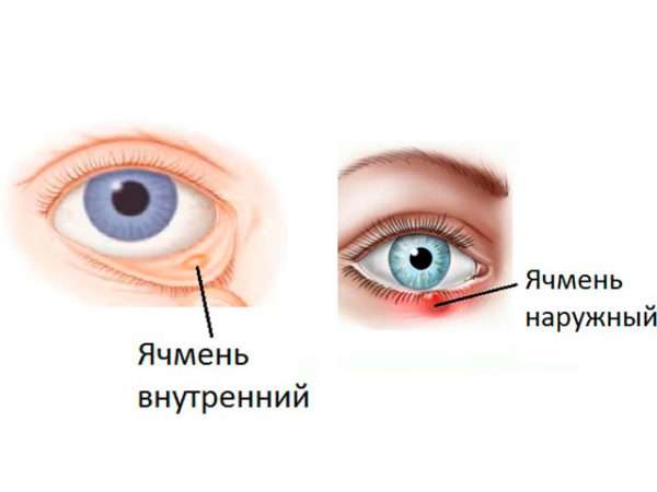 Фурункул на глазу у ребенка лечение