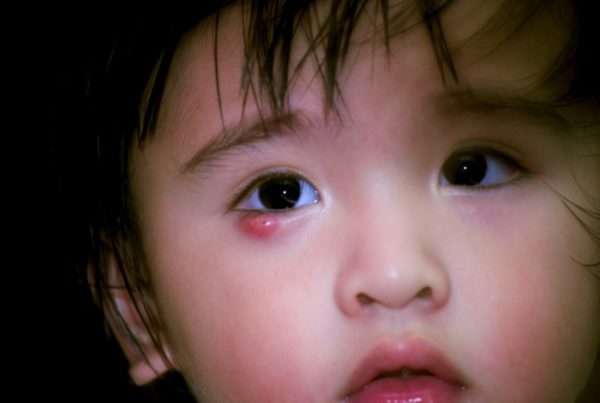 Чирей на глазу у ребенка 2 года лечение