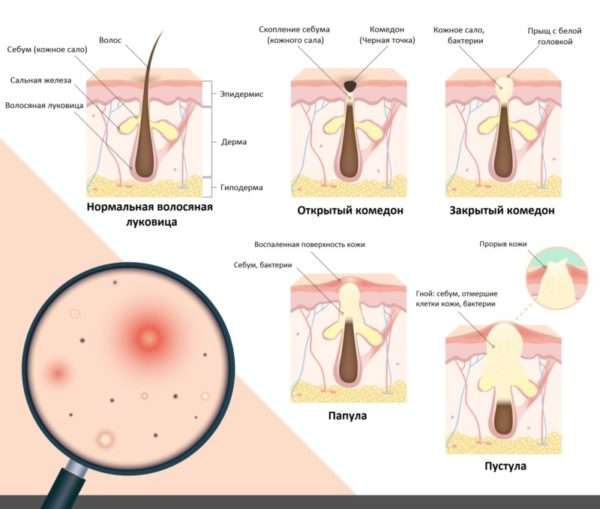 Косметология лечение угревой сыпи