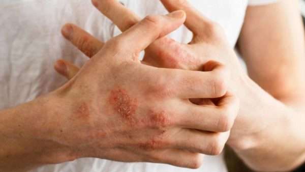 Лечение мокнущего дерматита народными средствами thumbnail