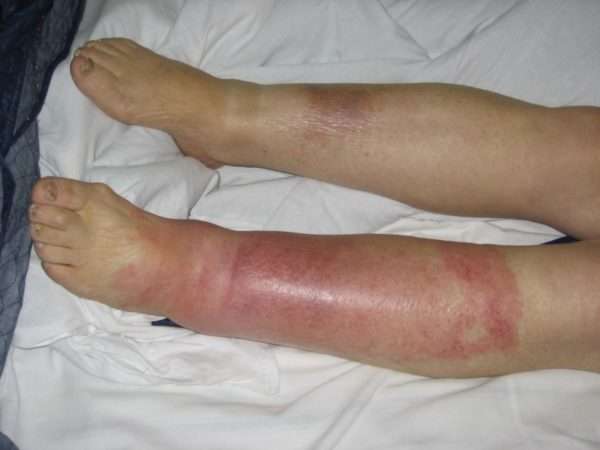 Лечение рожистого воспаления ноги мазями