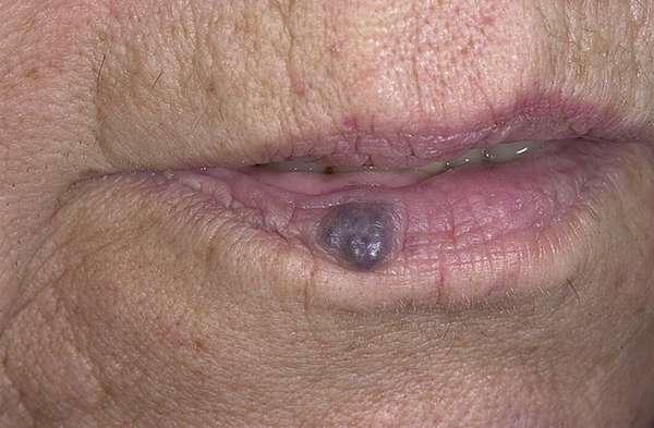 Лечение гемангиомы губы в домашних условиях