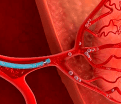 Эмболизация простатических артерий