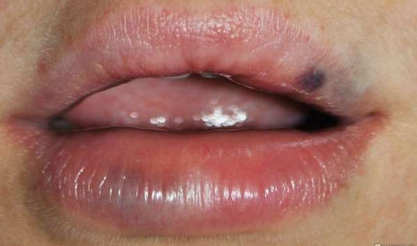 Избавиться от гематомы на губе