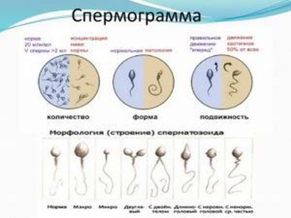 Для подтверждения присутствия антиспермальных антител проводят спермограмму