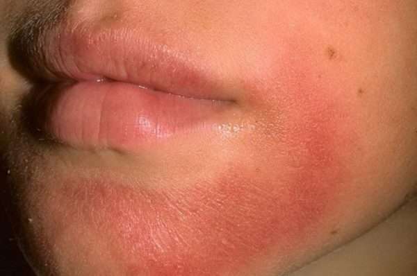 Мази от сухости кожи при аллергии