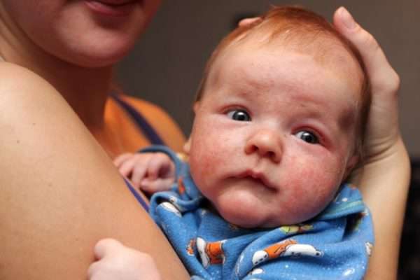 Причины гнойничковой сыпи у новорожденных