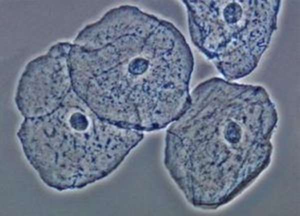 Клетки эпителия в моче