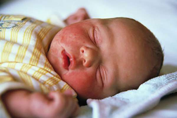 Сыпь у новорожденного дерматит