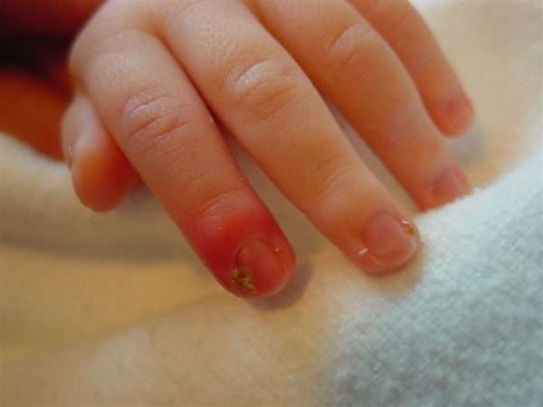 Как вылечить панариций на пальце руки у ребенка