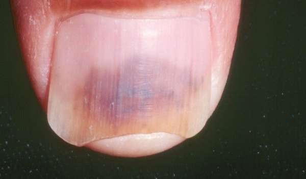 Гематома ногтя ноги лечение