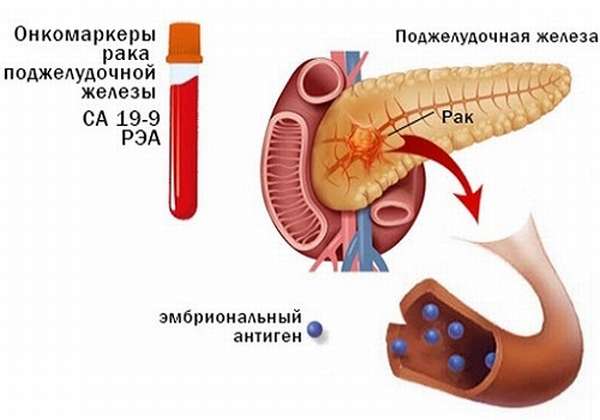 Анализ крови при опухоли поджелудочной железы thumbnail