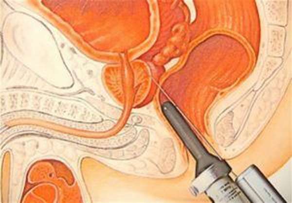 биопсия предстательной железы