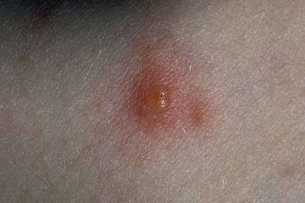Сыпь ребенка в виде комариных укусов