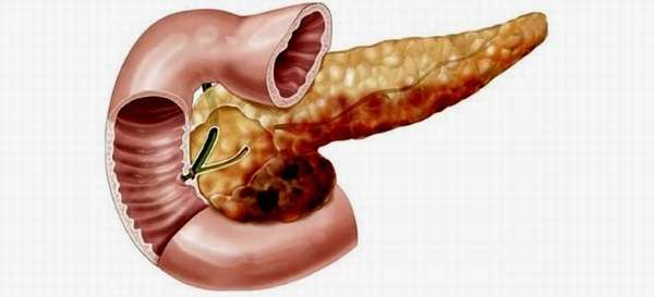 Что является причиной и симптомами панкреонекроза поджелудочной железы?