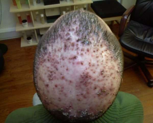 Воспаление волосяной фолликулы на коже головы