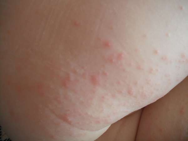 Высыпания в виде укуса комара на коже ребенка