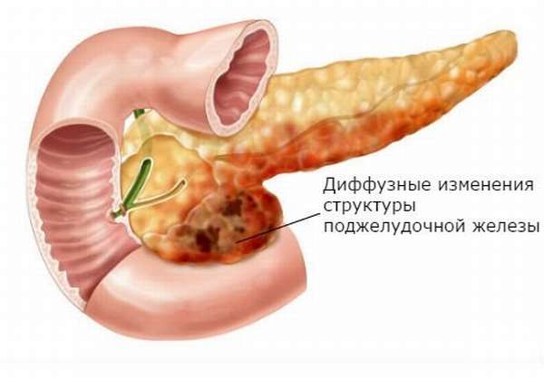 Обменно тканевые изменения поджелудочной железы thumbnail