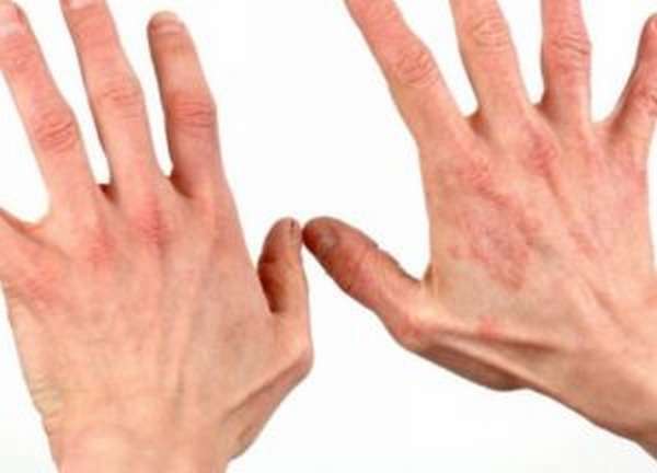 аллергия на руках