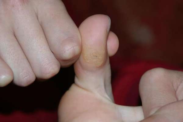 Нарост мозоль на сгибе большого пальца ноги
