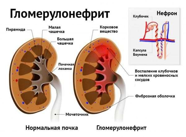 Что вызывает ангину стафилококк или стрептококк