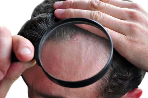 Физиотерапия при псориазе волосистой части головы