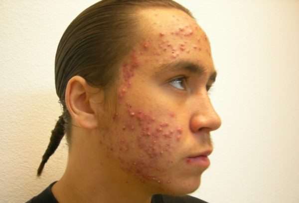 Сыпь на лице косметолог лечение