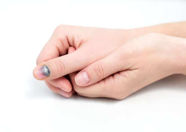 Слоятся ногти у ребенка при анемии